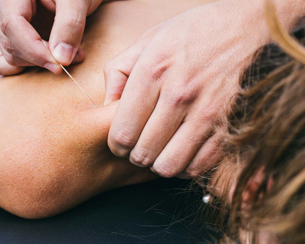 Dry-Needling-Physio