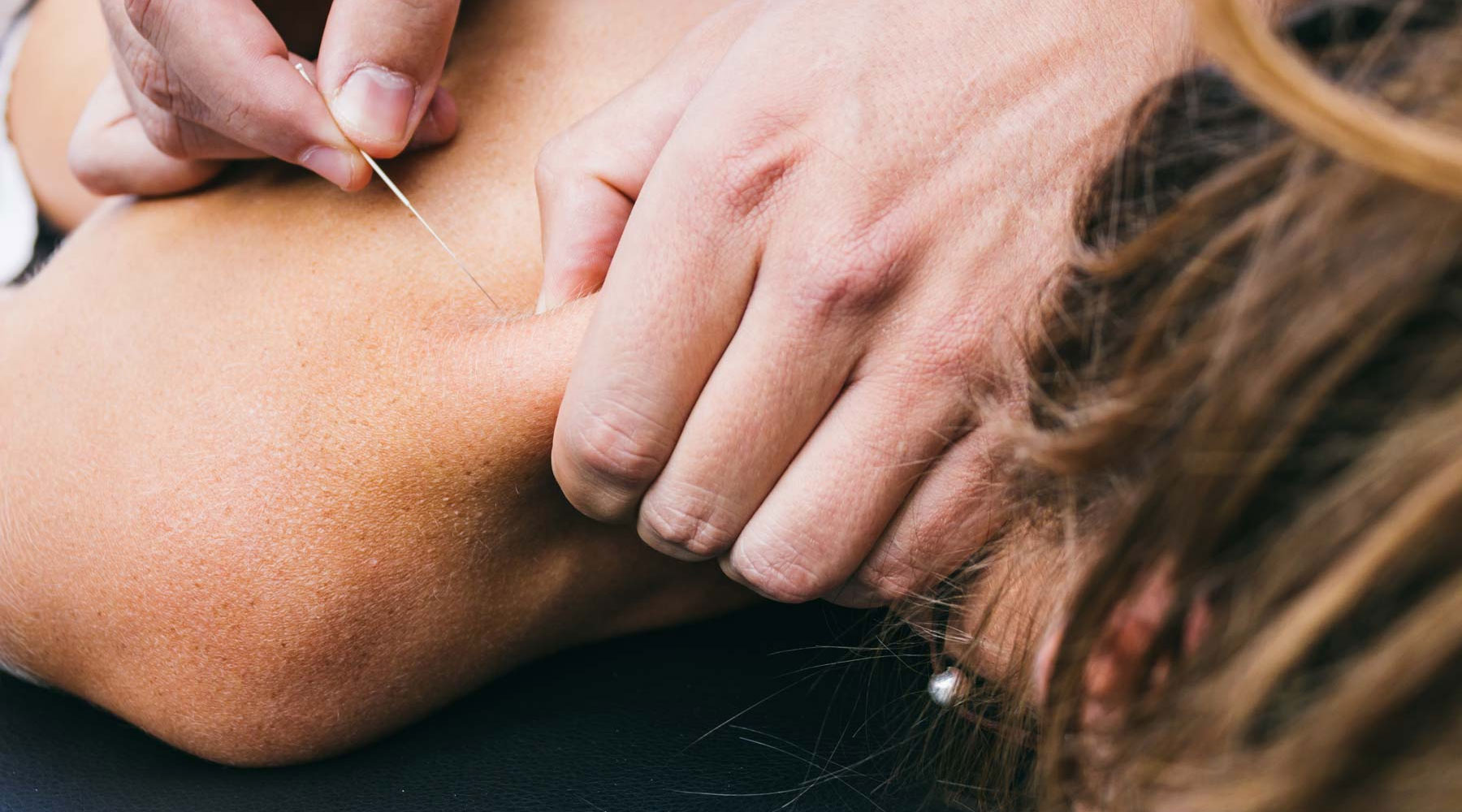 Dry Needling